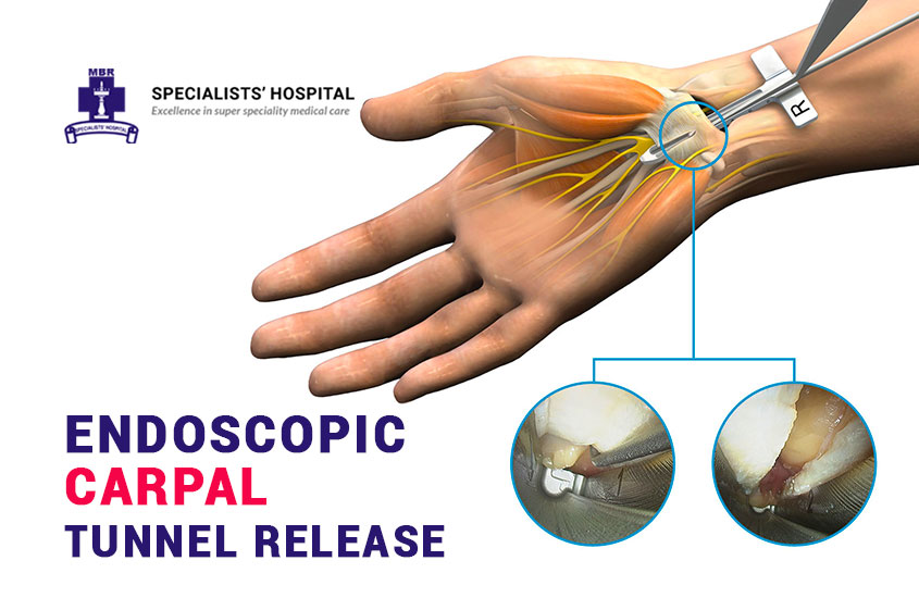 Carpal Tunnel Syndrome Surgery Endoscopic Carpal Tunnel Syndrome Surgery Endoscopic