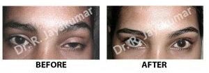 Treatment for Misaligned eyes